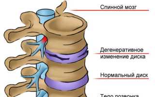 Остеохондроз с корешковым синдромом упражнения