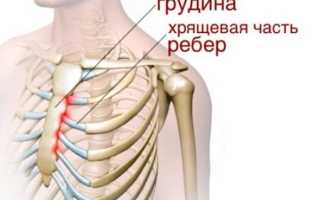 Синдром титце как и чем лечить