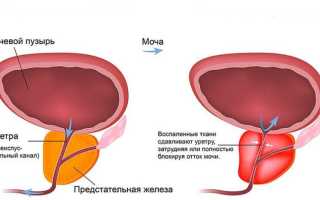 Синдром хронической тазовой боли ростов