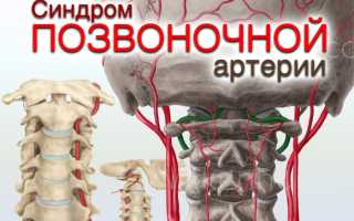Синдром позвоночной артерии как лечить