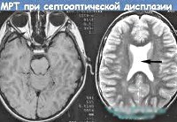 Септооптическая дисплазия