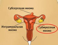 D25.0 Подслизистая лейомиома матки