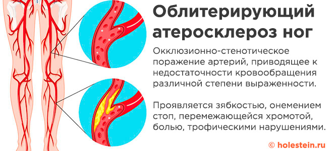 Атеросклероз ног с облитерацией
