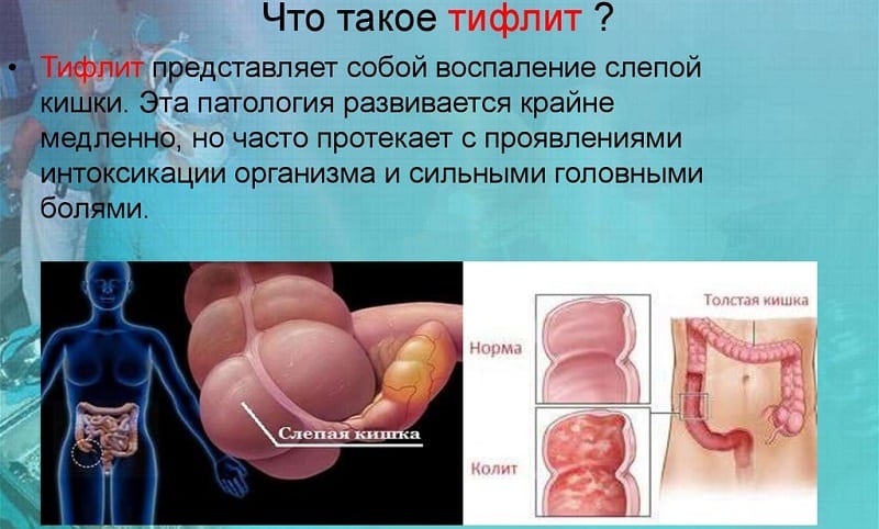 Что такое тифлит: чем опасен и как его лечить