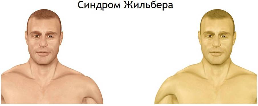Gilbert-Syndrome
