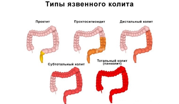 Воспалительный процесс может проходить не только в отдельных кишечных отделах, но и на всем протяжении кишечника.