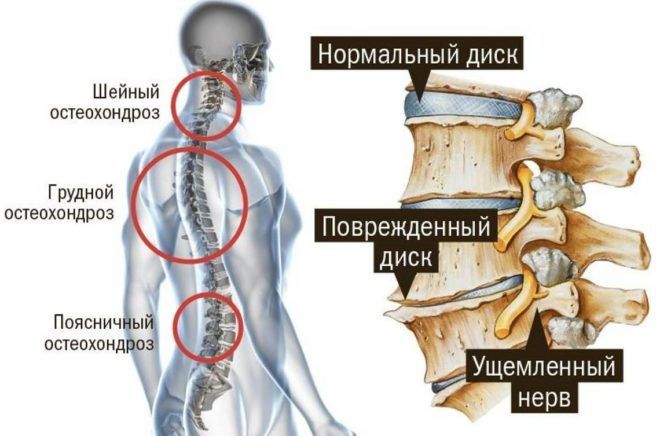 Поражение дисков и позвонков может произойти в любом отделе позвоночника