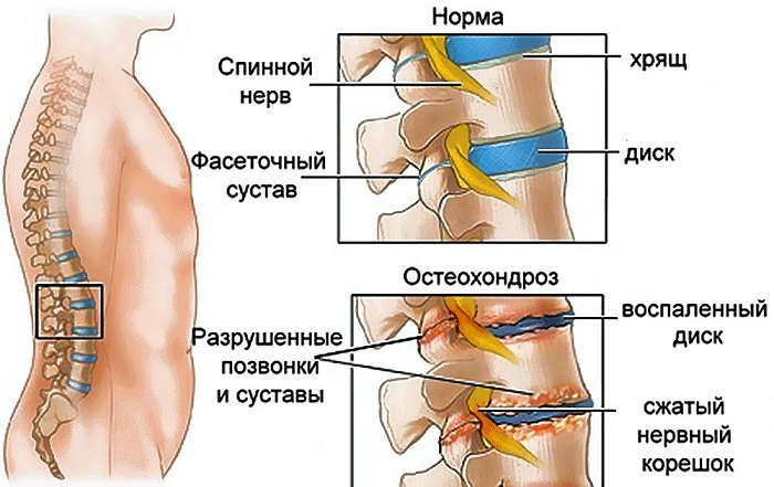 При остеохондрозе происходит постепенное разрушение структуры тканей, диски истончаются, сдавливаются и воспаляются нервные корешки