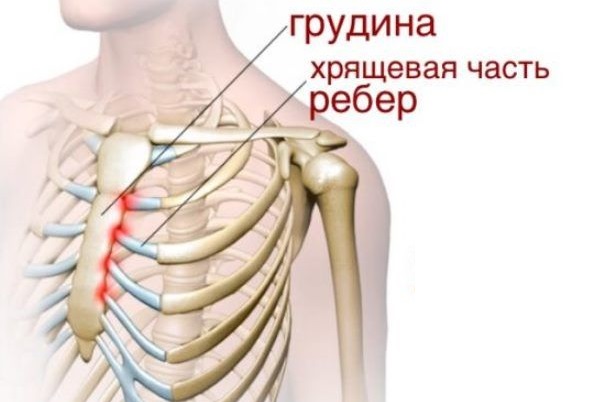 Синдром титце как и чем лечить