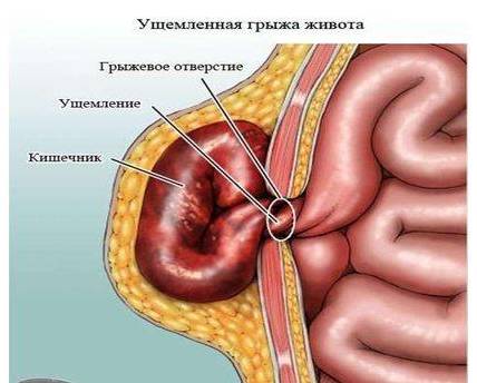 Код мкб ущемленная пупочная грыжа