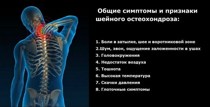 Остеохондроз с корешковым синдромом упражнения