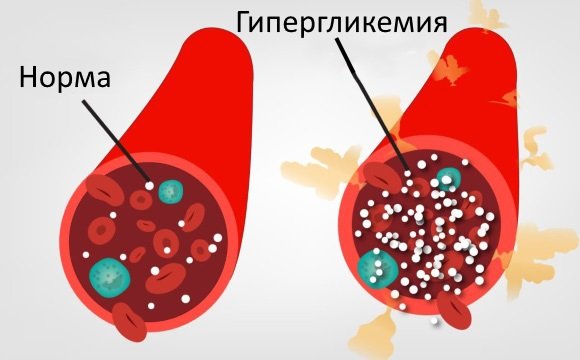 Гипергликемия провоцирует развитие энцефалопатии
