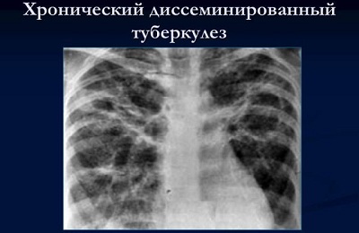 Хроническая диссеминация