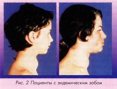 Внешний вид больных с эндемическим зобом