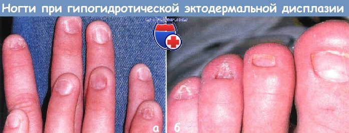 Гипогидротическая эктодермальная дисплазия