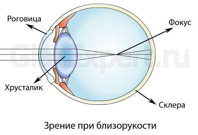Куда падает фокус при близорукости