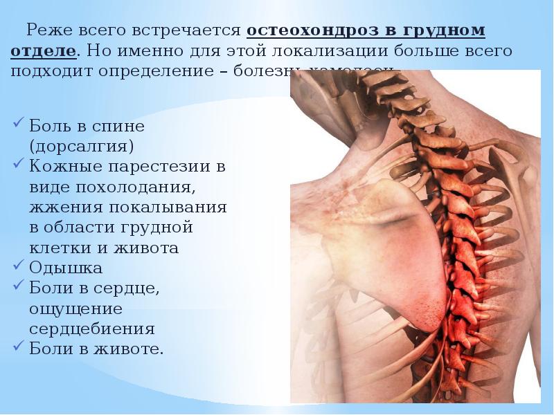 Остеохондроз с корешковым синдромом упражнения