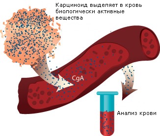 Повышенный уровень серотонина при карциноиде