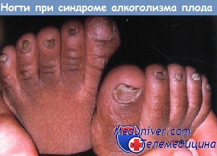 Ногти при синдроме алкоголизма плода