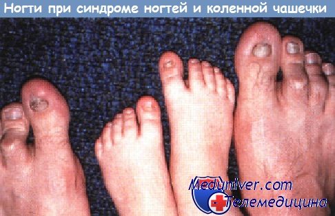 Ногти при синдроме ногтей и коленной чашечки