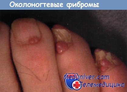 Околоногтевые фибромы
