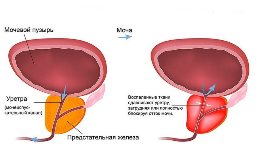 Простатит