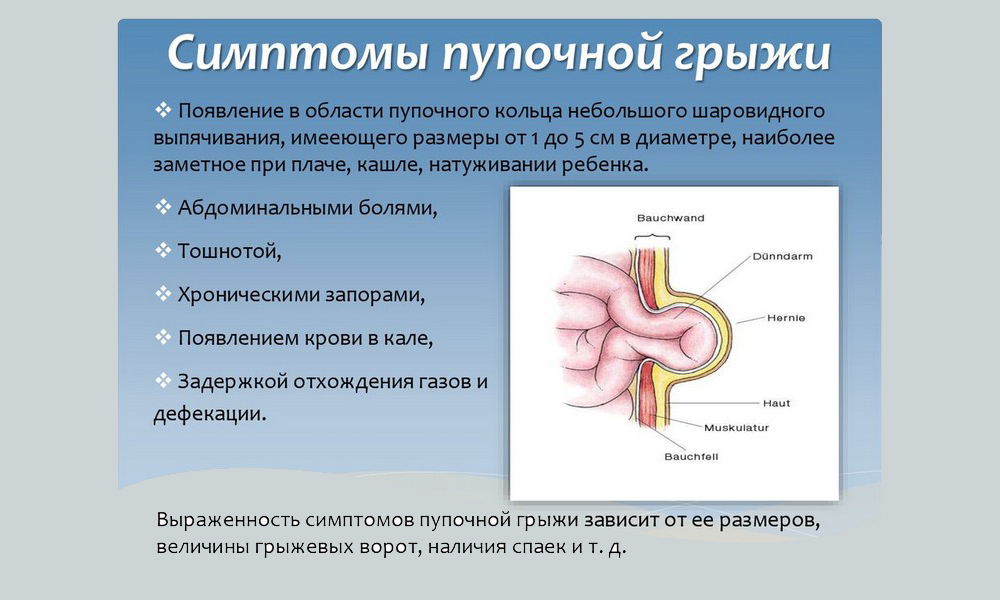 Код мкб ущемленная пупочная грыжа