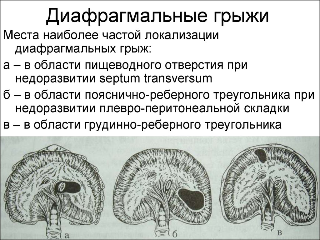 Код мкб ущемленная пупочная грыжа