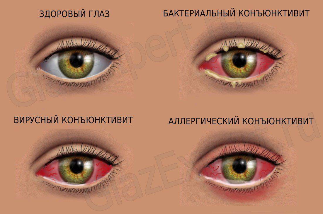 Разные виды конъюнктивита