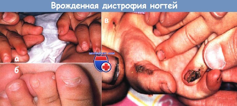 Врожденная дистрофия ногтей