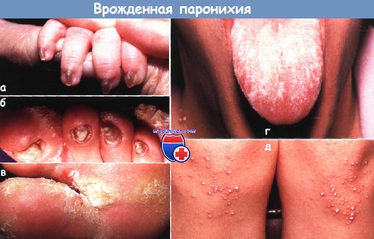 Врожденная паронихия