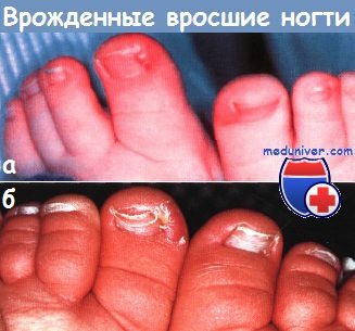 Врожденные вросшие ногти